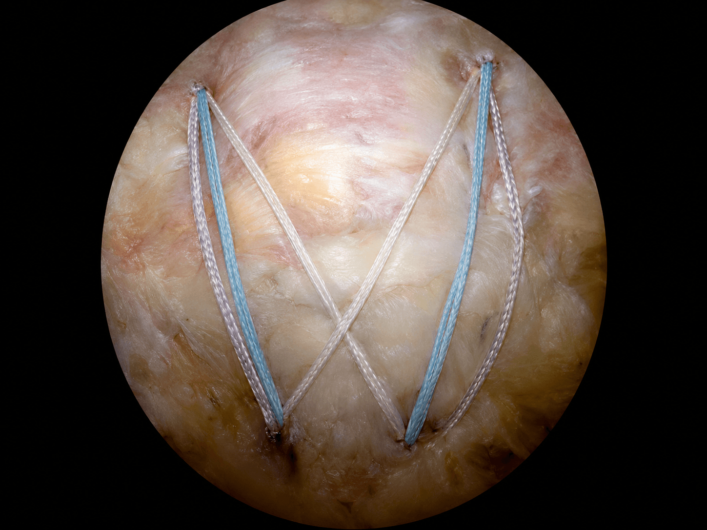 Réparation arthroscopique de la coiffe — vue per-opératoire