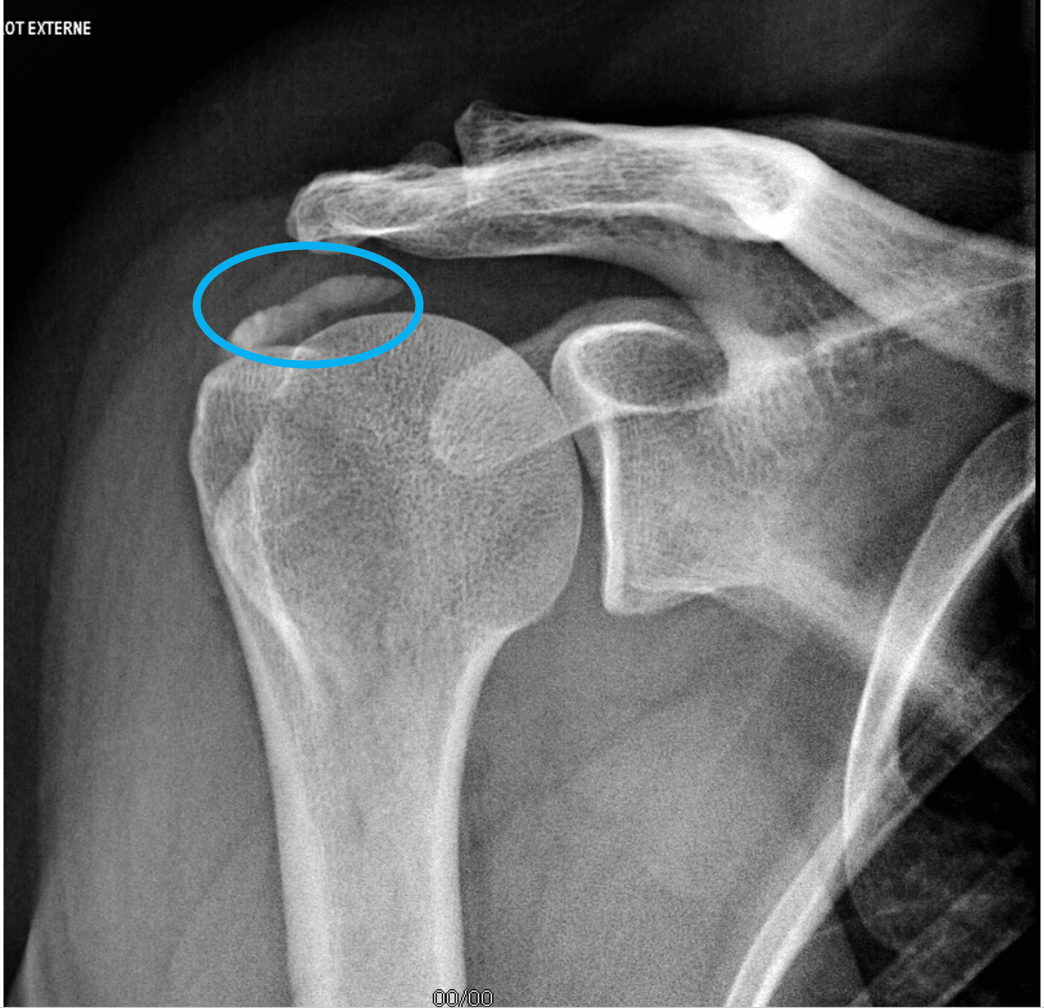 Calcification de l'épaule