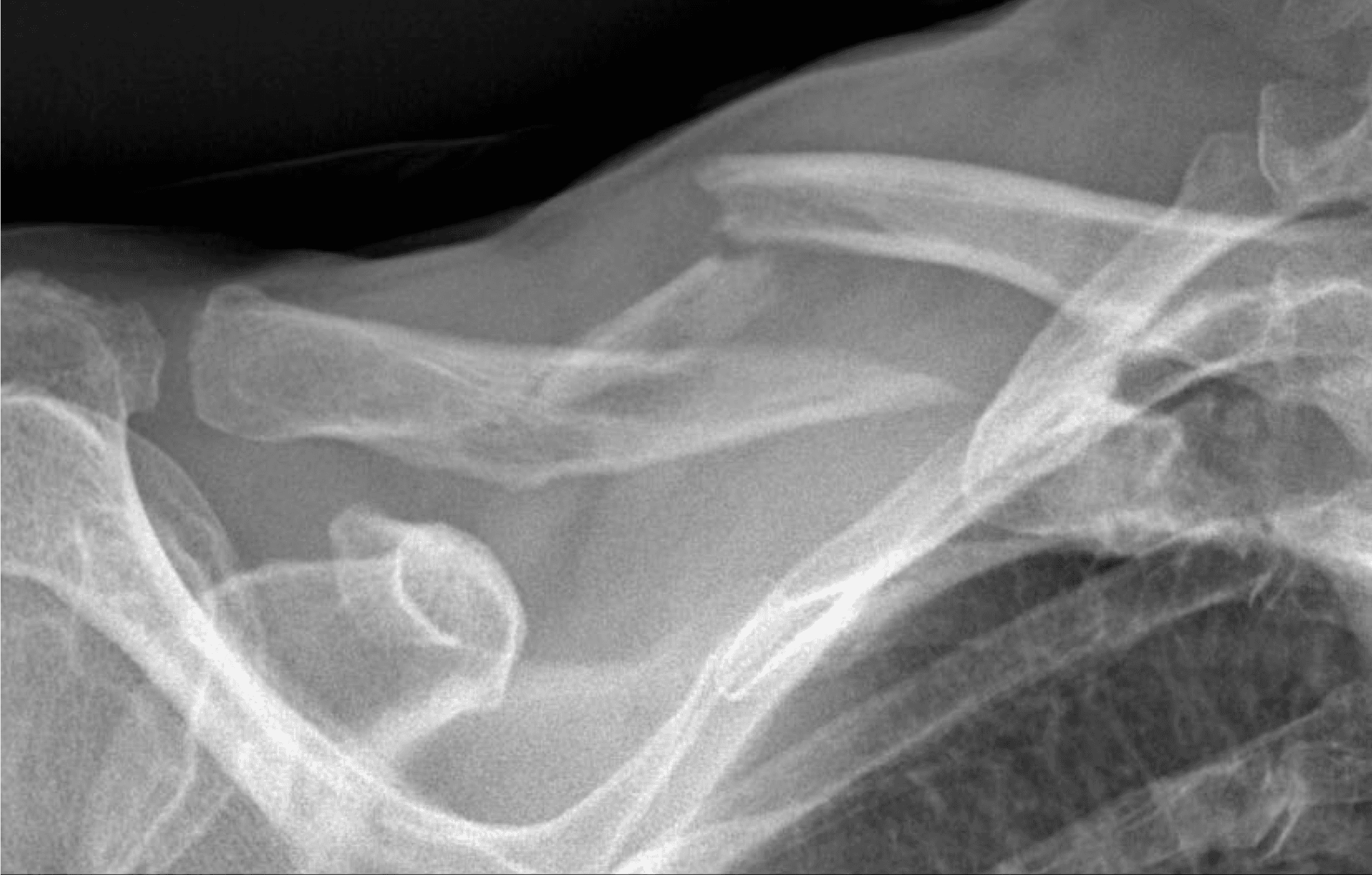 Fracture de la clavicule